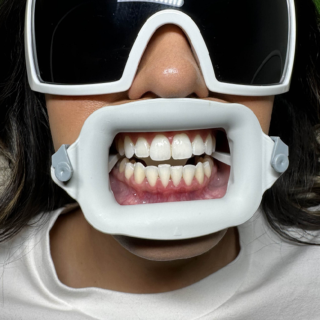 Free Shipping Dentist Using Super Soft Silicone Mouth Opener No Harm Mouth Ppener Oral Cheek Retractors